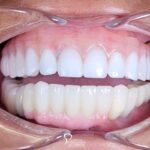 implant dentures dental